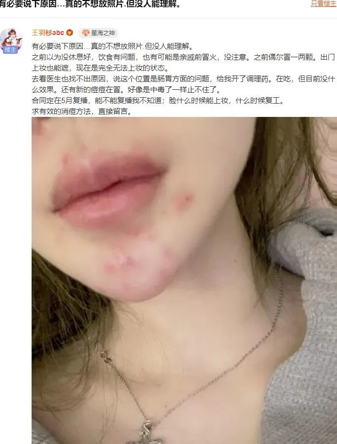 二次元一姐王羽杉王阿姨复播在即!皮肤状况令人堪忧! | 黑料正能量